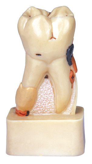 Dissected Model of Dental Disease For Hospitals And Medical Schools Training