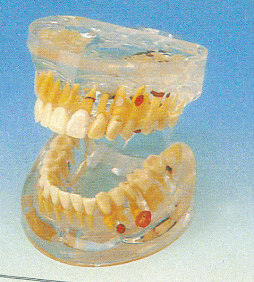 Adult Transparent Dental Pathology  Human Teeth Model for Colleges Training