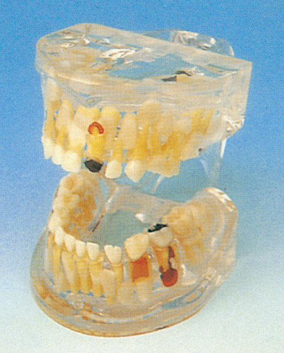 Human Teeth Model / Lucid Pathology of Milk Teeth Model for Dental Schools Training