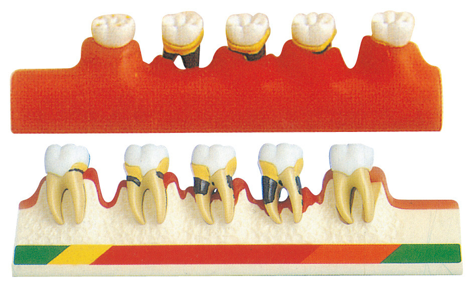 Periodontal Disease Model includes 5 Parts for Dental Schools Training