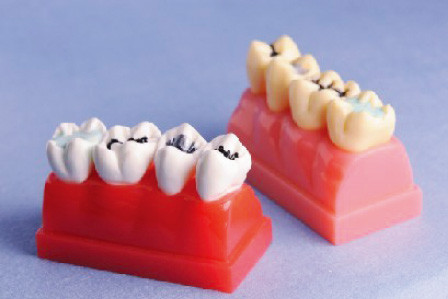 Human Teeth Model for Sealant and Inlay Demonstration Model of 4 Times Lifesize