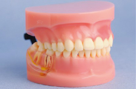 Model of Periodontal Disease Human Teeth Model for Medical Colleges and Clinic Training